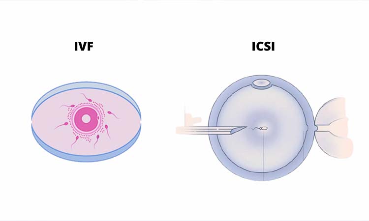 Top 5 Best ICSI Treatment Centres in Vijayawada 2021